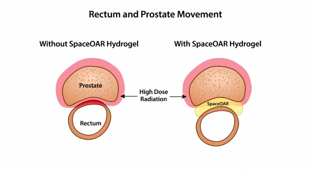Is advanced prostate cancer terminal