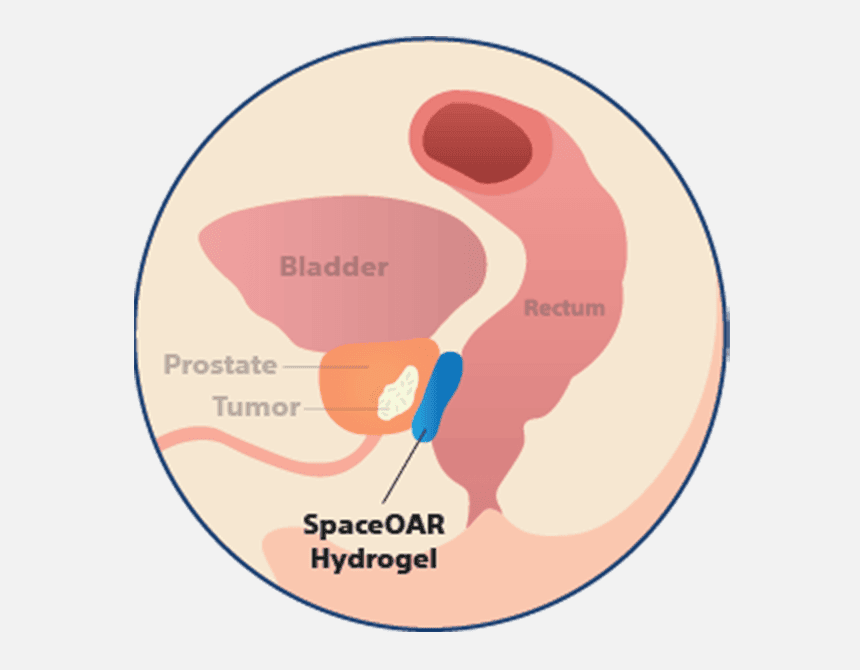 Anatomy with SpaceOAR Hydrogel illustration.