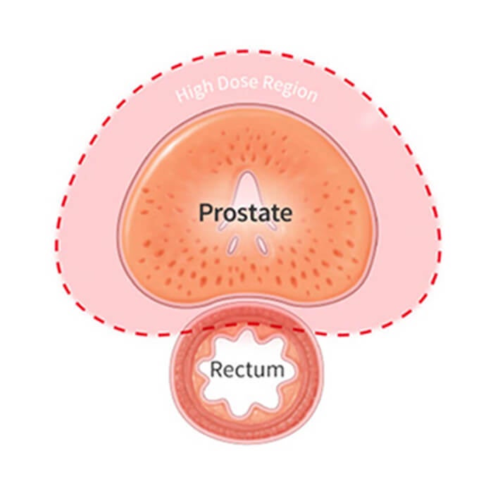 Illustration without SpaceOAR Hydrogel.