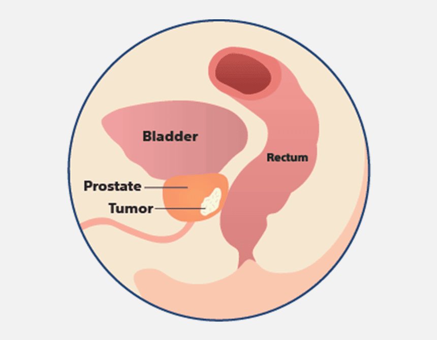 Anatomy without SpaceOAR Hydrogel illustration.