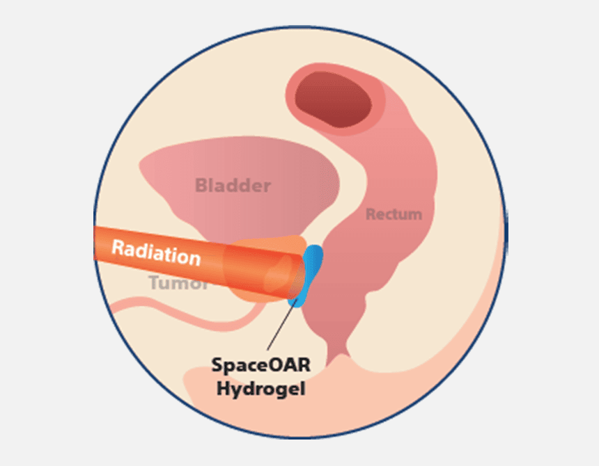 SpaceOAR Hydrogel with radiation illustration.
