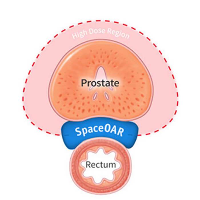 Illustration with SpaceOAR Hydrogel in place.